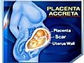 PlacentaAccretaDangersofMultipleCSections