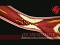 Observezdeprsuneangioplastie