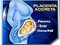 PlacentaAccretaDangersofMultipleCSections