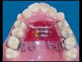 Ortodontidehangitipdistellerikullanilir
